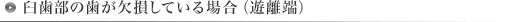 臼歯部の歯が欠損している場合（遊離端）