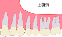 上顎洞